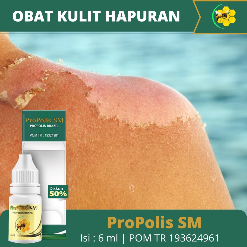 Obat Hapur, Obat Hapuran Kulit, Obat Penghilang Hapur, Obat Panu, Di Badan Wajah Leher, Obat Kulit Panu, Obat Herbal Penghilang Panu, Obat Panu Merah, Salep Penghilang Kurap, Obat Gatal PanU Dengan Propolis SM Brazil Asli