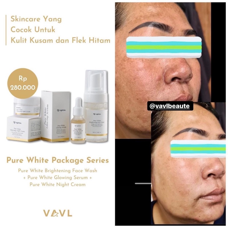 VAVL Pure White Brightening Glowing Series BPOM (Pemutih wajah,Penghilang Bekas Jerawat,Flek Hitam)