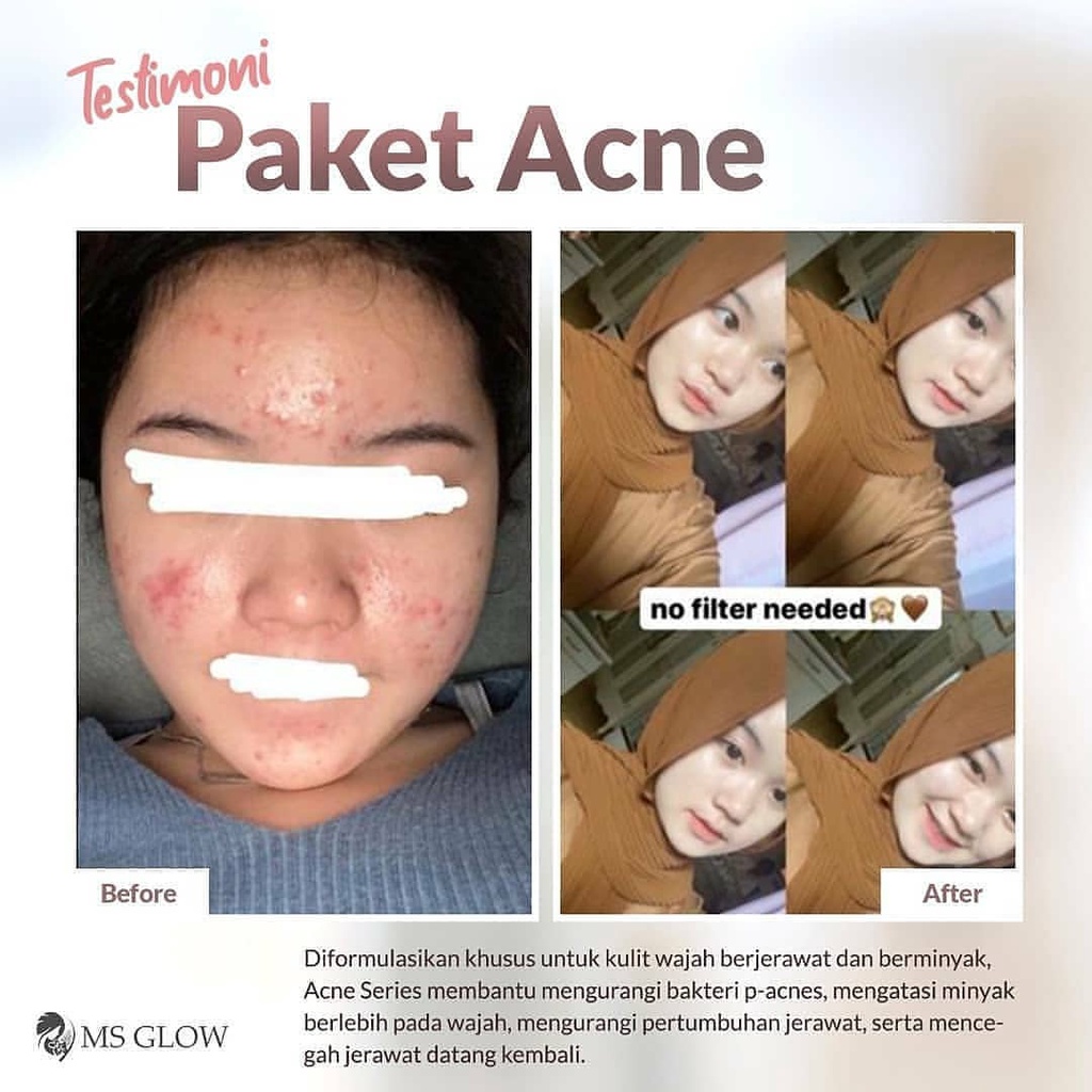 Ms Glow Acne Free Tote Bag Paket Ms Glow Acne Series Ms Glow Original BPOM Skincare Wanita Meredakan Jerawat dan Bruntusan-5