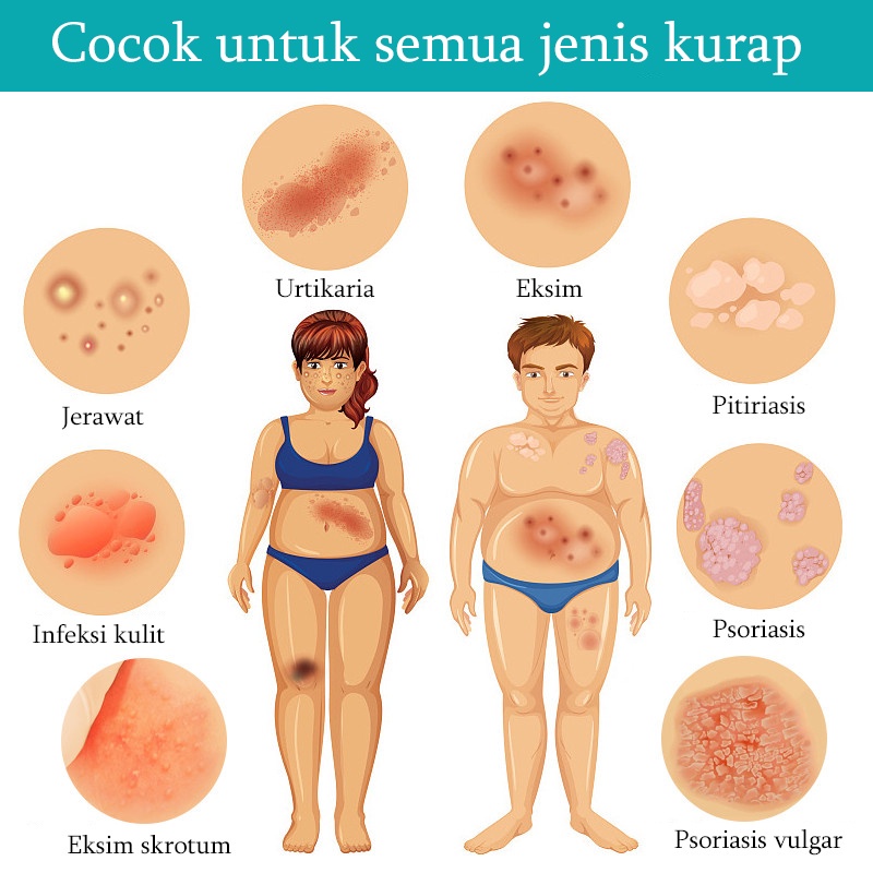 Salep Gatal Obat Gatal Kulit 20g Kulit Kepala Psoriasis Tangan Tinea Kaki Bau Versicolor Menghambat Dermatitis Jamur Salep Gatal Paling Ampuh