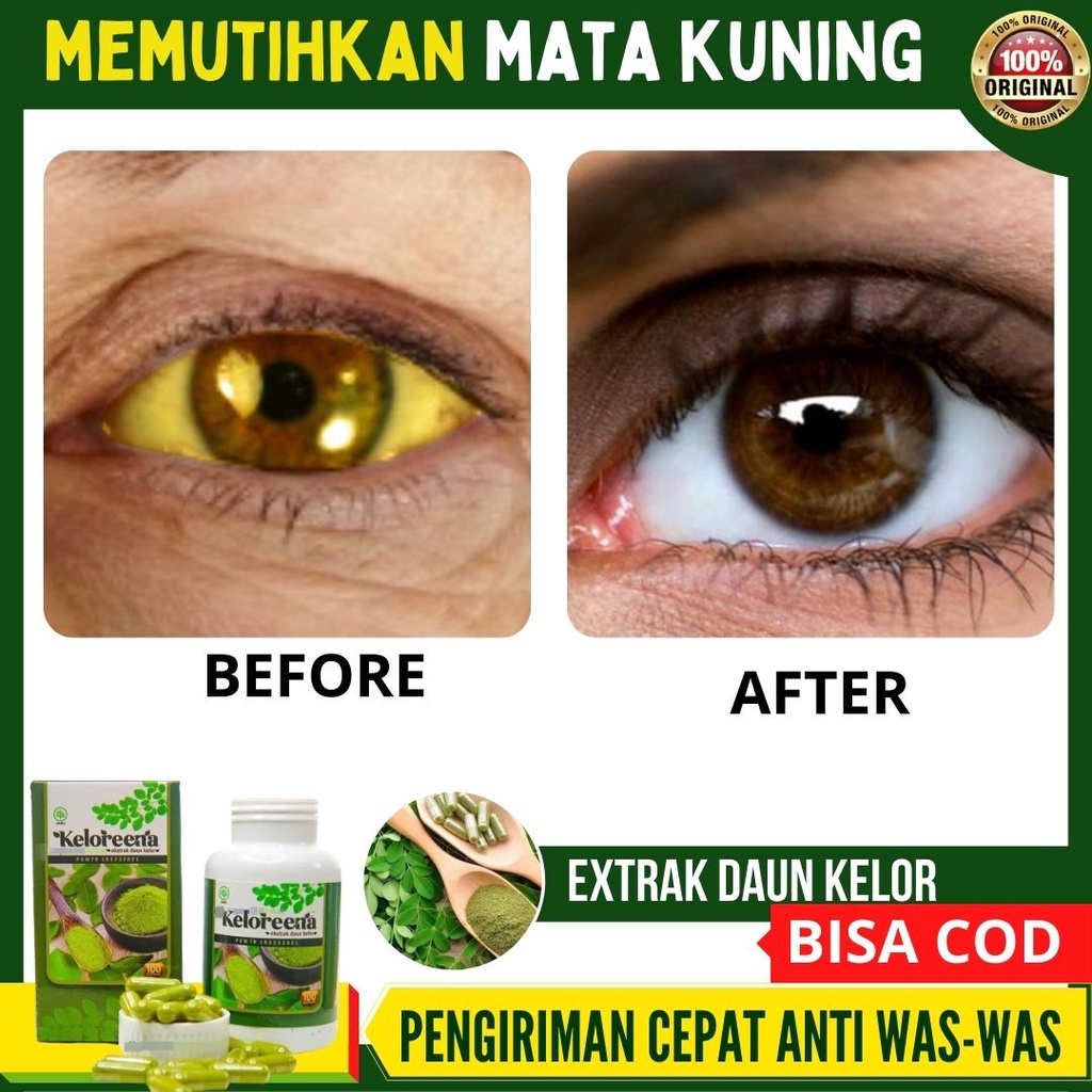 Obat Memutihkan Mata Keruh kekuningan, obat tetes mata yang kuning, Suplemen Mata Kuning berlemak,KE