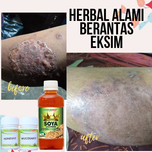 

Herbal alami mengatasi eksim