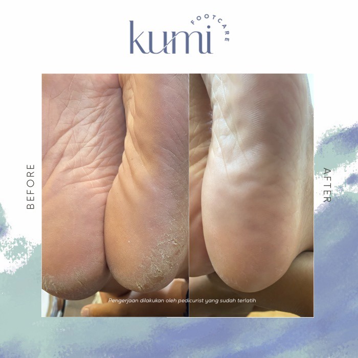 Kumi Callus Softener /  Pedicure / Footcare / Perawatan Kaki Kapalan dan Pecah-pecah