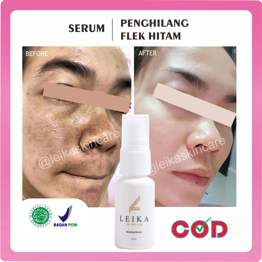 PROMO LEIKA SERUM PENGHILANG FLEK HITAM WAJAH TERBUKTI AMPUH MENGHILANGKAN FLEK HITAM PADA WAJAH 100