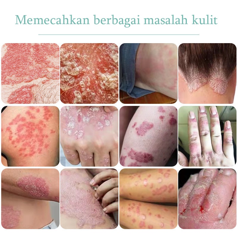 Salep Gatal Obat Gatal Kulit 20g Kulit Kepala Psoriasis Tangan Tinea Kaki Bau Versicolor Menghambat Dermatitis Jamur Salep Gatal Paling Ampuh