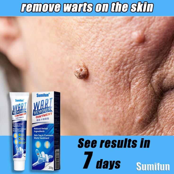 Warts Remover Cream Wart Treatment Skin Tags Mole Remover Plaster Cream Antibacterial Foot Wart Oint