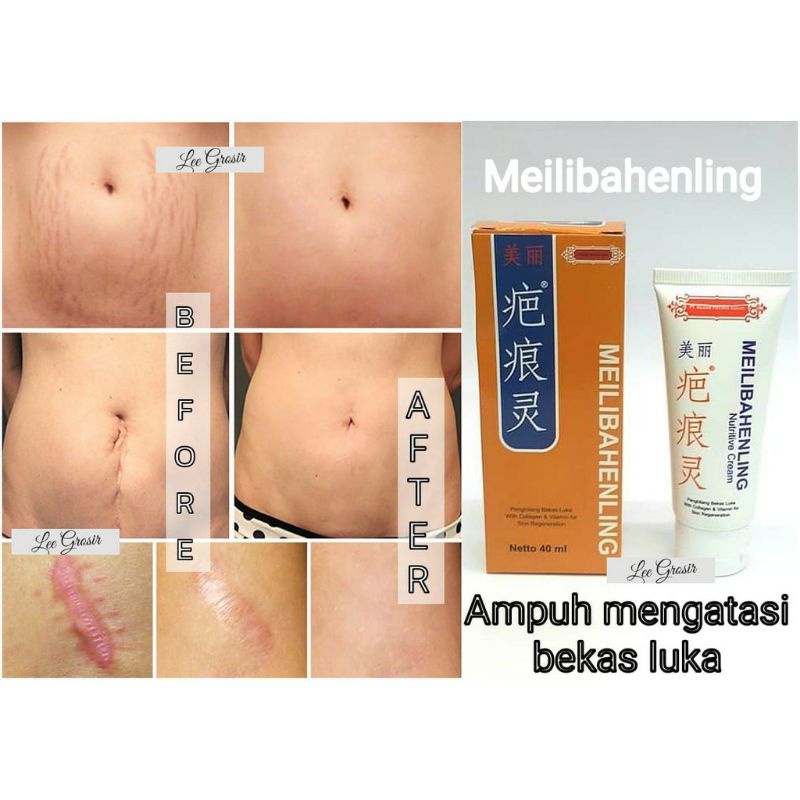 MEILIBAHENLING Cream Penghilang Bekas Luka | Stretch mark | Bekas Jerawat | Flek ORIGINAL BPOM