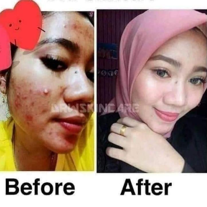 ☆ Paket Radiant Drw skincare (glow/acne/Acne Britening & Flek) Free tas cantik ☇