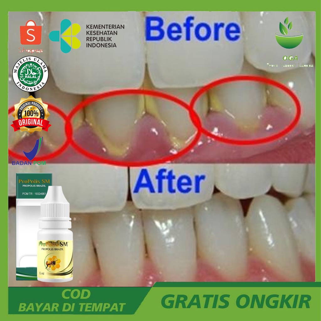 Obat Ajaib Penghancur karang Gigi /Pemutih gigi kuning Obat sakitGigi Ngilu / Penghilang Bau mulut