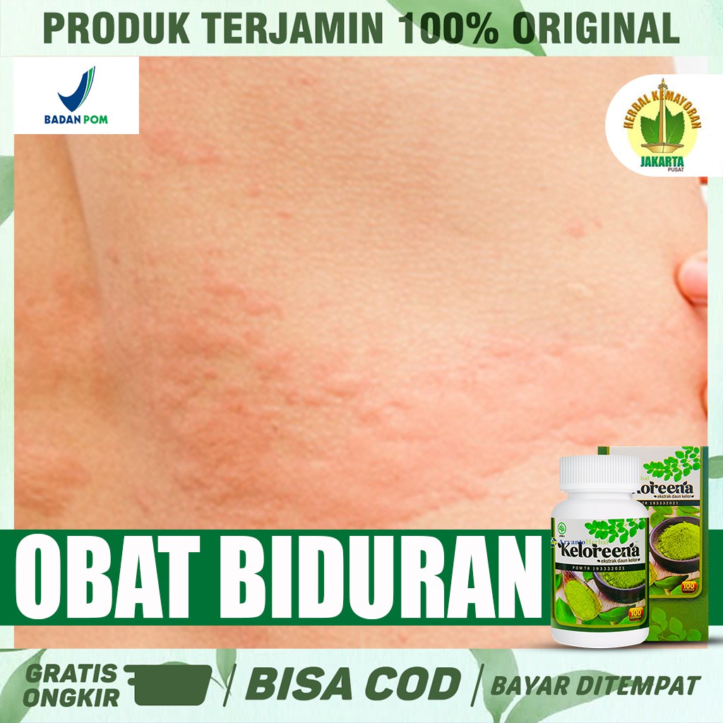 Obat Herbal Untuk Atasi Biduran, Gatal Seluruh Tubuh , Alergi Gatal Gatal Keloreena Kapsul Sudah BPO