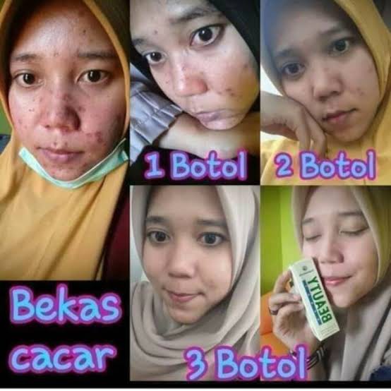 Obat CACAR Dan bisa Menghilangkan Bekas Cacar - Natura Beauty Spray - NBS ORIGINAL 100%-Serum multif