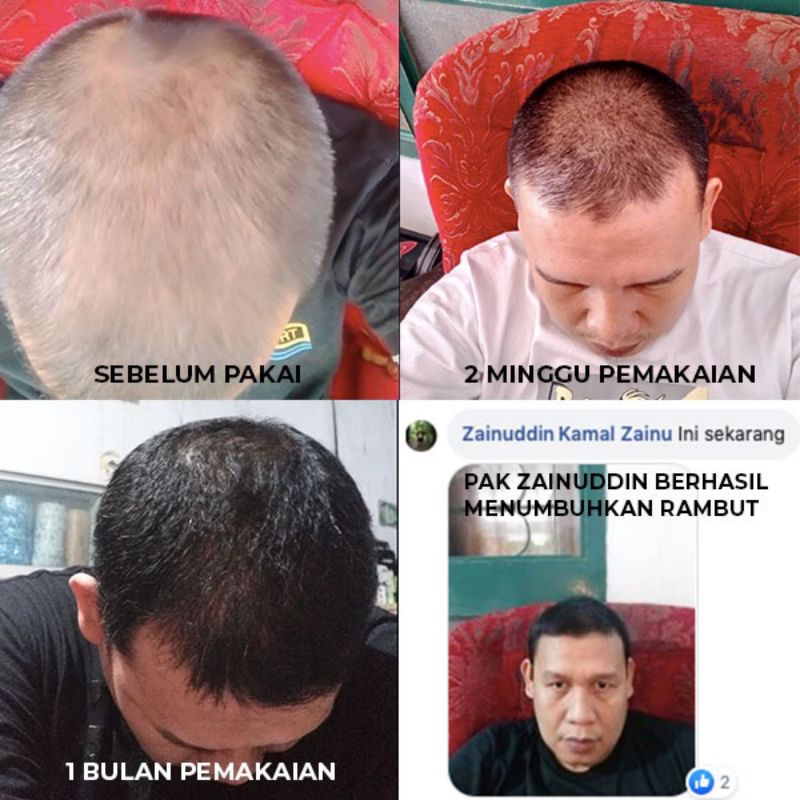 Kelaya Sampo - Shampo Penumbuh Rambut Paling Cepat Ampuh Atasi Rontok Parah Anti Ketombe Pitak Kelaya Anti Botak 250ml