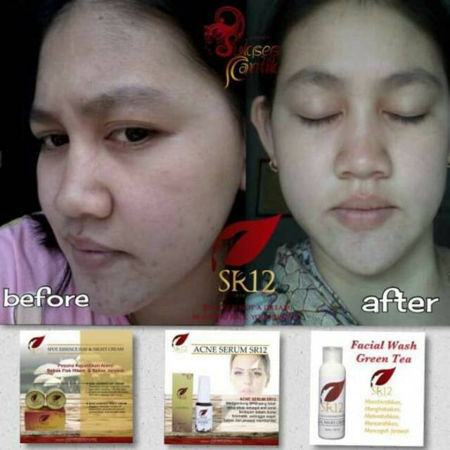 Acne Serum SR12 BPOM ORIGINAL