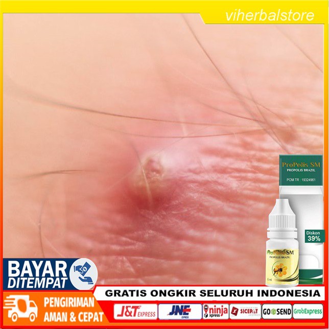 Obat Bisul Di Anus Obat Perontok Bisul Di Anus Obat Penghilang Benjolan Nyeri Di Anus Propolis Sm Shopee Indonesia