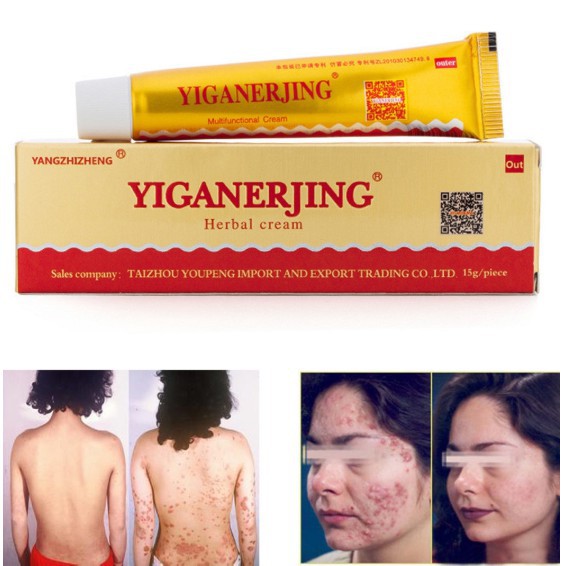 [100% Ampuh] Yiganerjing Salep Obat Gatal Alergi Jamur Kudis Kurap Bakteri Kulit Herbal Cream