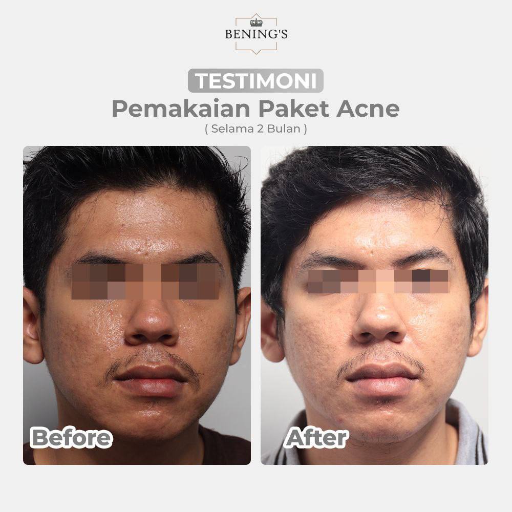 Bening Skincare Dr Oky Pratama Paket Acne Terbaik (Free Gift) Benings Skincare - Benings Clinic Paket Jerawat-7