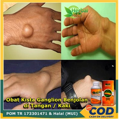 Obat Penghilang Kista Ganglion, benjolan di pergelangan tangan, kista di tangan, kista ganglion di k