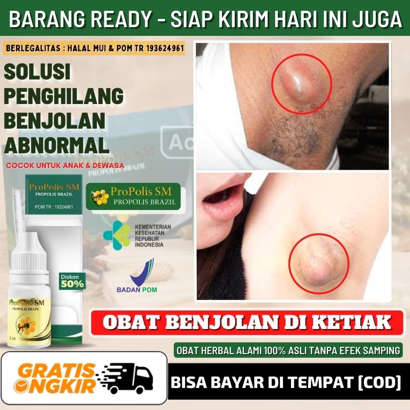 Salep Alami Bisul Bernanah di Ketiak, Borok di Ketiak,  Penghancur Bisul di Tubuh, Benjolan Keras di