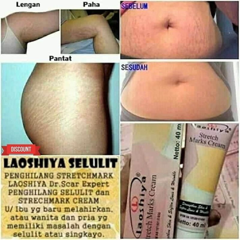 CREAM PENGHILANG STRETCH MARK SELULIT GURATAN KULIT di Perut Kaki Tangan | Laoshiya Cream BPOM