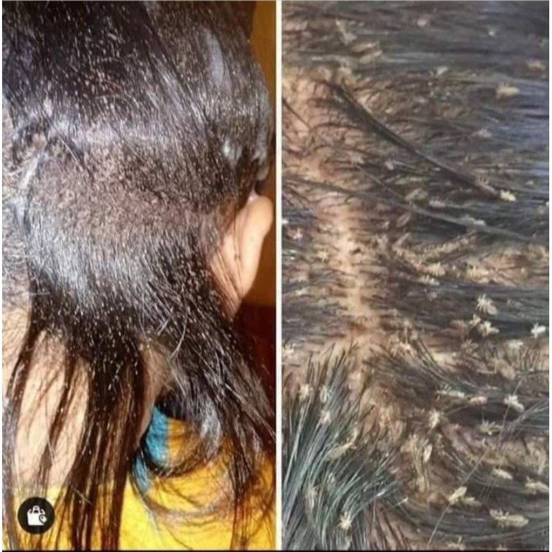 MYWAY KIDDY SHAMPOO ANTI LICE