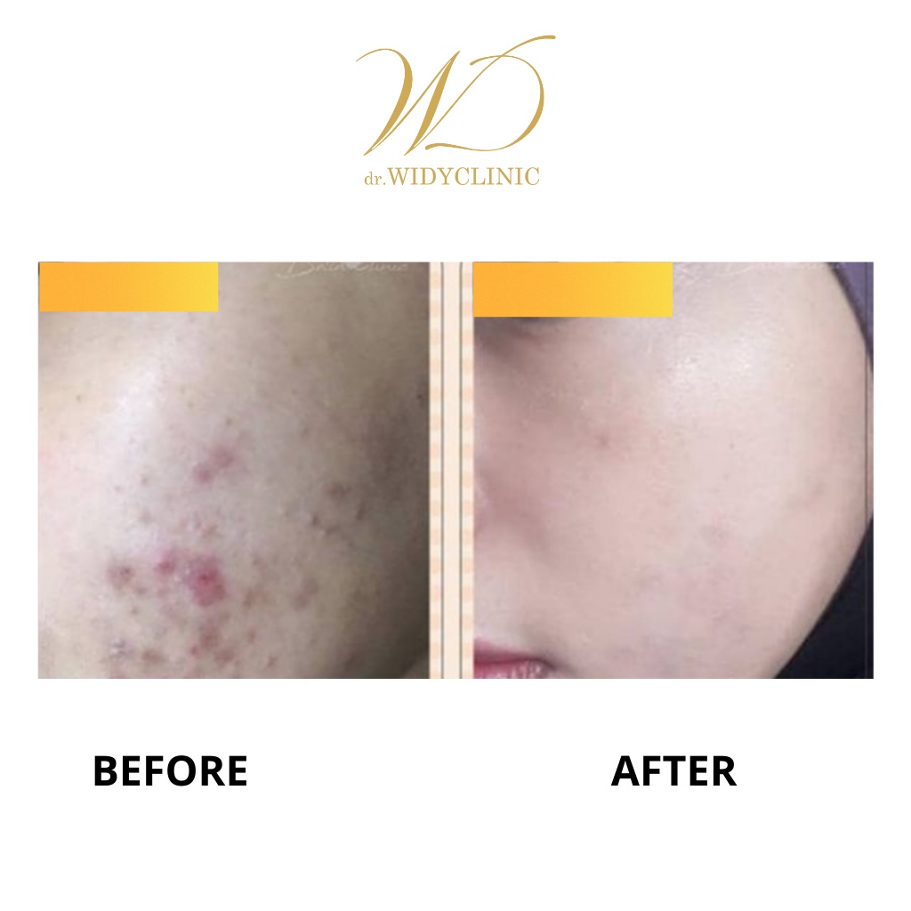 Skincare Acne dr Widy Clinic | Produk Satuan Krim Serum Sabun Toner Jerawat Mencerahkan Kulit Wajah | BPOM &amp; Halal MUI | Obat Jerawat Formulasi Dokter