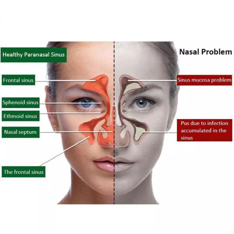 Semprotan Hidung Untuk Membantu Meringankan Sinusitis Rhinitis Pilek