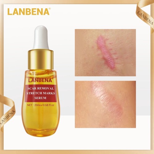 LANBENA SCAR REMOVAL STRETCH MARKS SERUM Penghilang Bekas Luka Stretch Mark