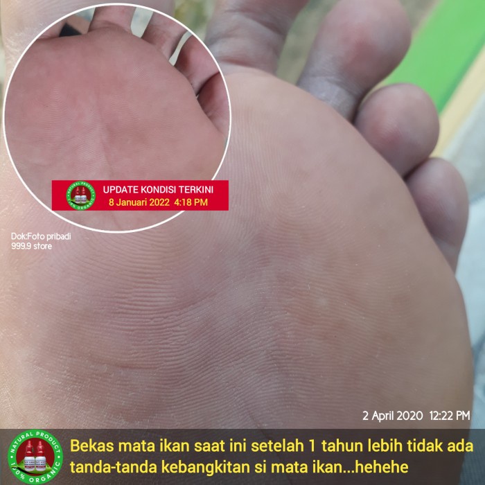 PALING LARIS OBAT PENYAKIT MATA IKAN ATAU CLAVUS BUKAN PLESTER SALEP CALLUSOL K: