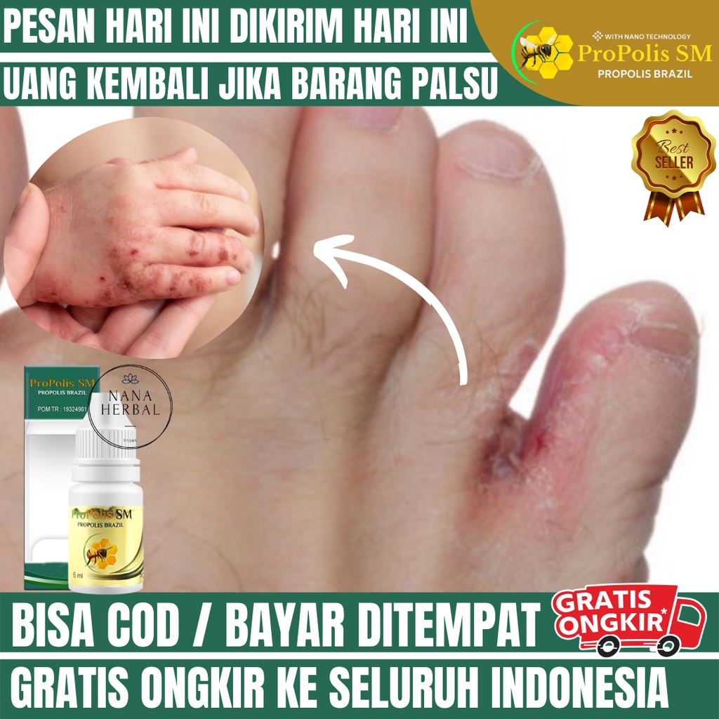 OBAT KUTU AIR, OBAT KUMAN AIR DI KAKI, KUTU AIR DISELA SELA JARI, OBAT GATAL KUTU AIR, KUTU AIR GATA