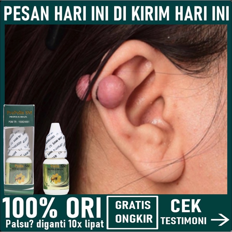 Penghilang Keloid / Daging Tumbuh  / Skin tag di Telinga - Pengempis Keloid Menahun - Obat Keloid