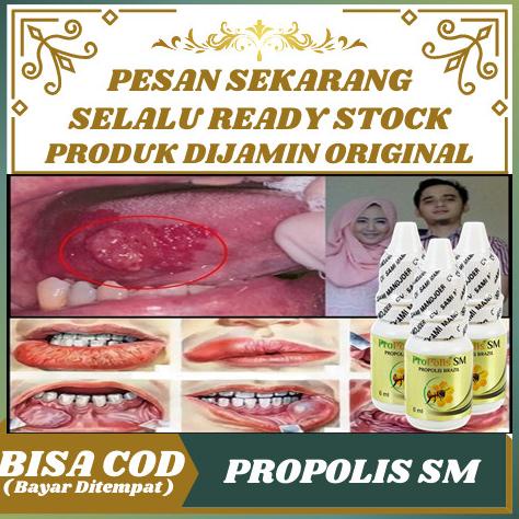 Propolis SM Obat Kanker Mulut, Kanker Lidah, Kelenjar Air Liur Herbal