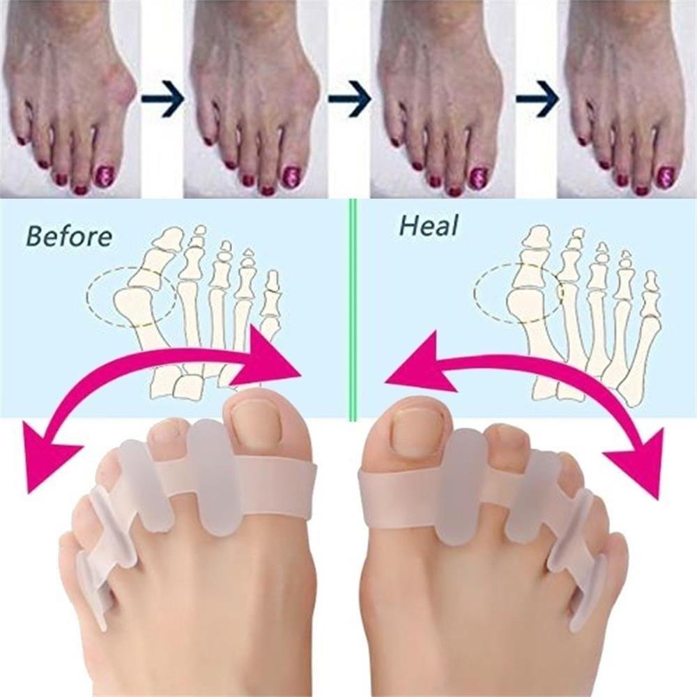 Suyo 1pasang Pemisah Jari Kaki Silikon Mudah Digunakan Perawatan Kesehatan Pereda Nyeri Align Toes Foot Care Tools