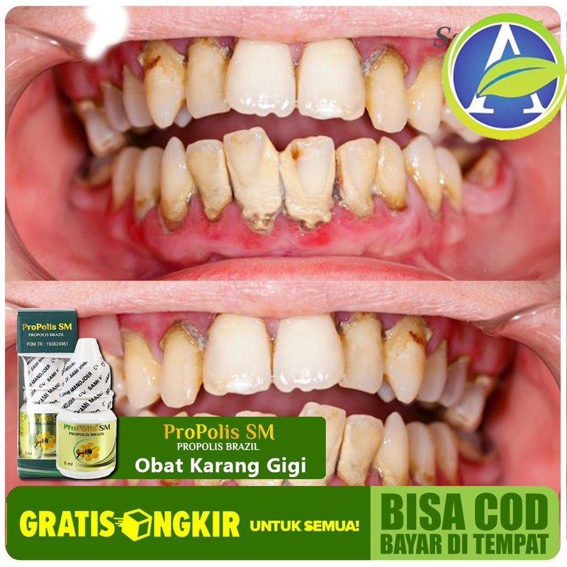 Obat Karang Gigi, Penghancur Karang Gigi, Menghilangkan Karang Gigi Herbal PROPOLIS SM 100% Aman