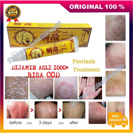[BISA COD] Obat Herbal Cina Atasi Psoriasis Eksim Cream Psoriasis Ampuh 100% ORIGINAL