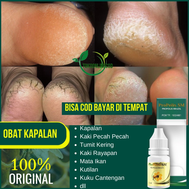 Obat Kapalan Kaki - Kapalan Tangan - Mata Kaki Kapalan - Callus - Kapalan - Propolis SM [di Oles]