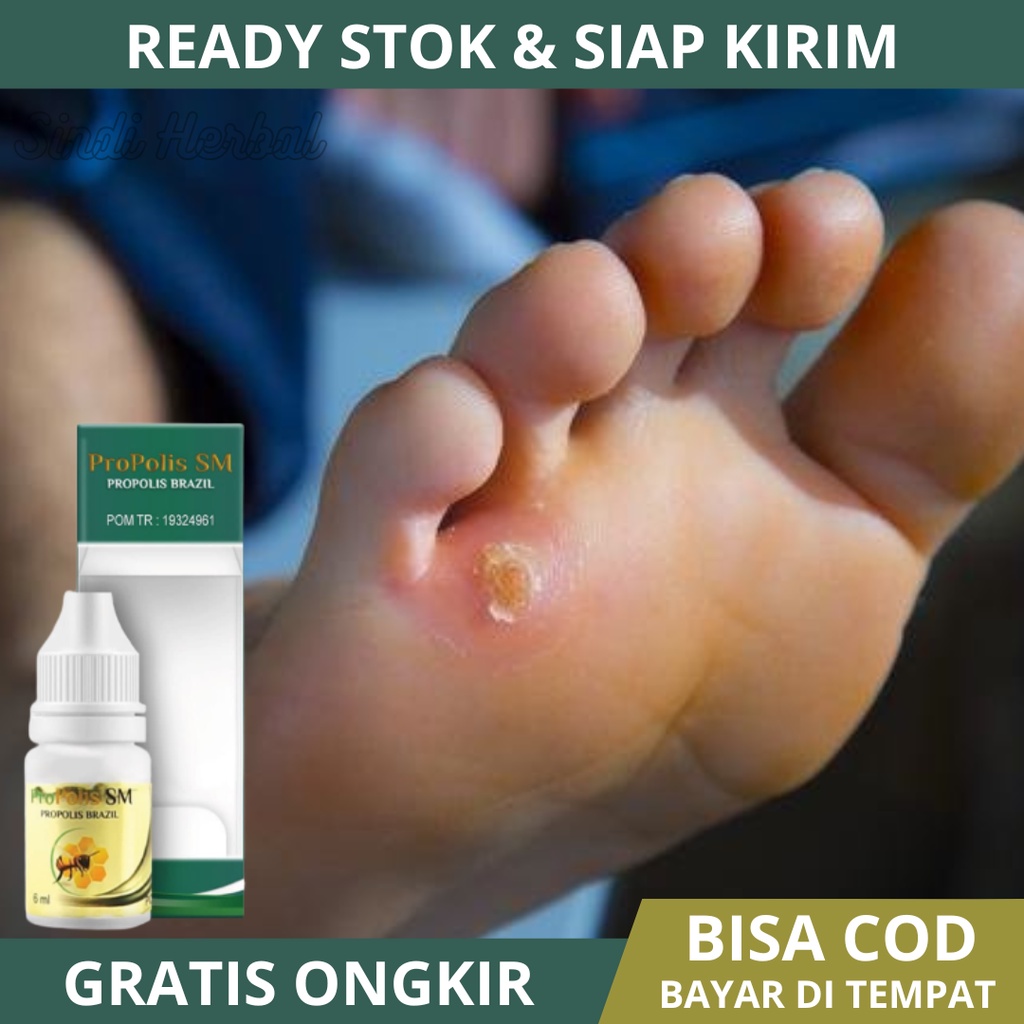 Obat Mata Ikan, Obat Mata Ikan di Telapak Kaki / Tangan, Obat Mata Ikan Di Jari Tangan, Obat Mata Ik