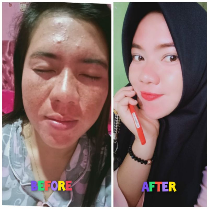 SALEP FLEK AMPUH || SALEP FLEK NIGHT || SALEP FLEK HITAM || SALEP MELASMA || CREAM FLEK || SALEP FLEK MEMBANDEL