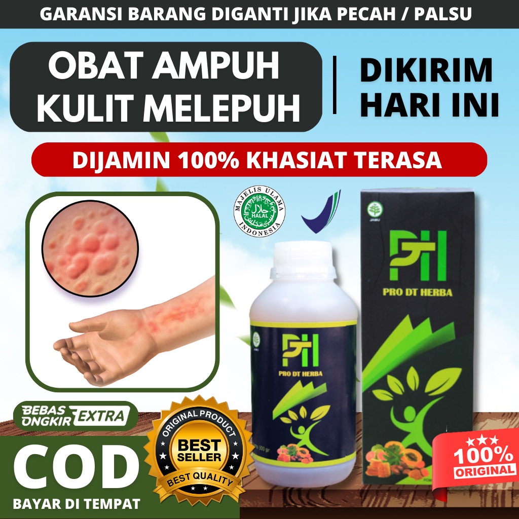 Obat Kulit Melepuh, Obat Luka Bakar Paling Ampuh Sembuh, Luka Bakar Kenalpot, Luka Bakar Di Wajah, L
