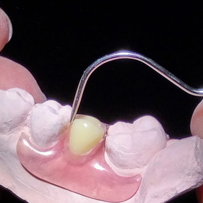 Terlaris Valplast Unilateral Baby