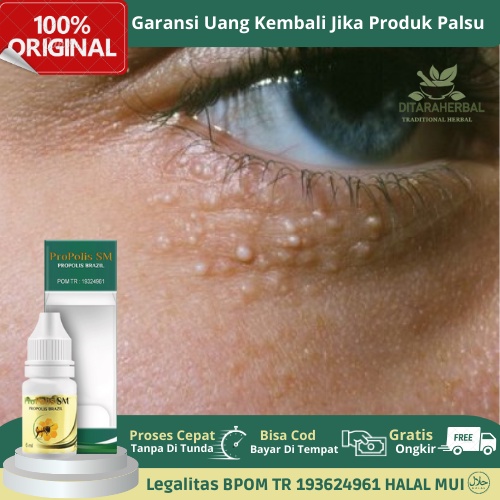 Obat Milia, Obat Milia Di Bawah Mata, Milia Pada Wajah, Milia Di Kelopak Mata, Milia Di Bibir, Obat 