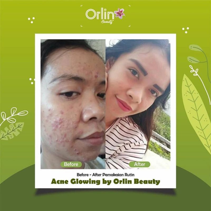 orlin paket hemat jerawat / paket acne hemat