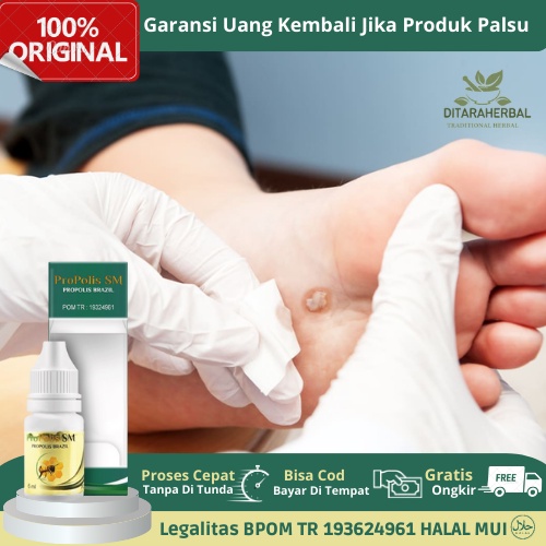 Obat Mata Ikan, Obat Mata Ikan Telapak Kaki, Obat Tetes Mata Ikan, Obat Penghilang Mata Ikan, Obat P