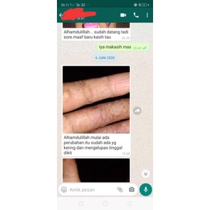 SALEP BL ORIGINAL 100% ASLI MENGHILANGKAN GATAL