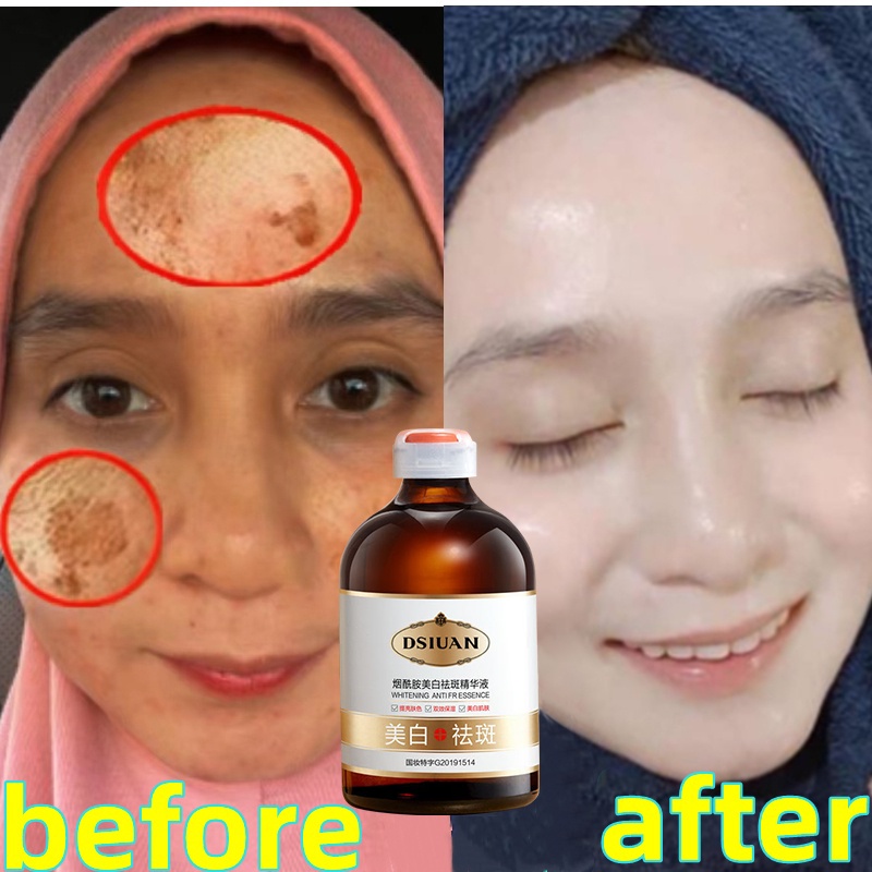 Niacinamide Pemutih Serum Penghilang flek Serum 100ml serum penghilang flek hitam yang ampuh Bintik Efektif Brightening Serum Flek Hitam Melasma Membandel Pencerah Wajah utuk Cerahkan Kulit Sensitif Kusam  Pigmen Gelap Melanin