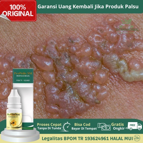 Obat Luka Kemaluan, Obat Luka Lecet Kemaluan, Obat Luka Kemaluan Pria Wanita, Obat Iritasi Kulit Kel