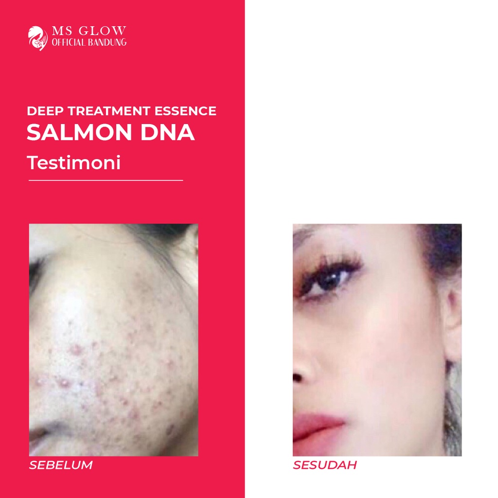 DTE Salmon DNA Deep Treatment Essence Glowing - Essence Pencerah Wajah - Untuk Semua Jenis Kulit BY MSGLOWOFFICIALBANDUNG