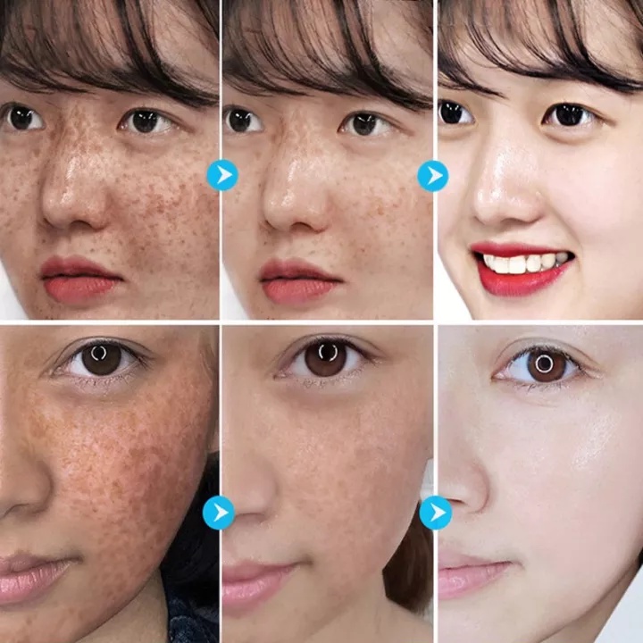 Niacinamide Pemutih Serum Penghilang flek Serum 100ml serum penghilang flek hitam yang ampuh Bintik Efektif Brightening Serum Flek Hitam Melasma Membandel Pencerah Wajah utuk Cerahkan Kulit Sensitif Kusam  Pigmen Gelap Melanin