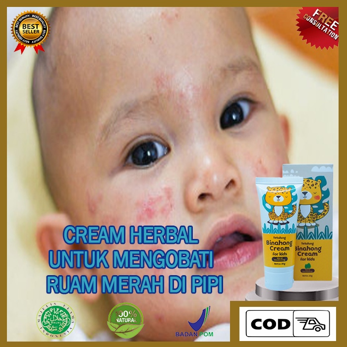 Cream Untuk Ruam Pipi Bayi , Biang Keringat Bayi Di Wajah , Penghilang Ruam Merah Gatal Pada Bayi, R