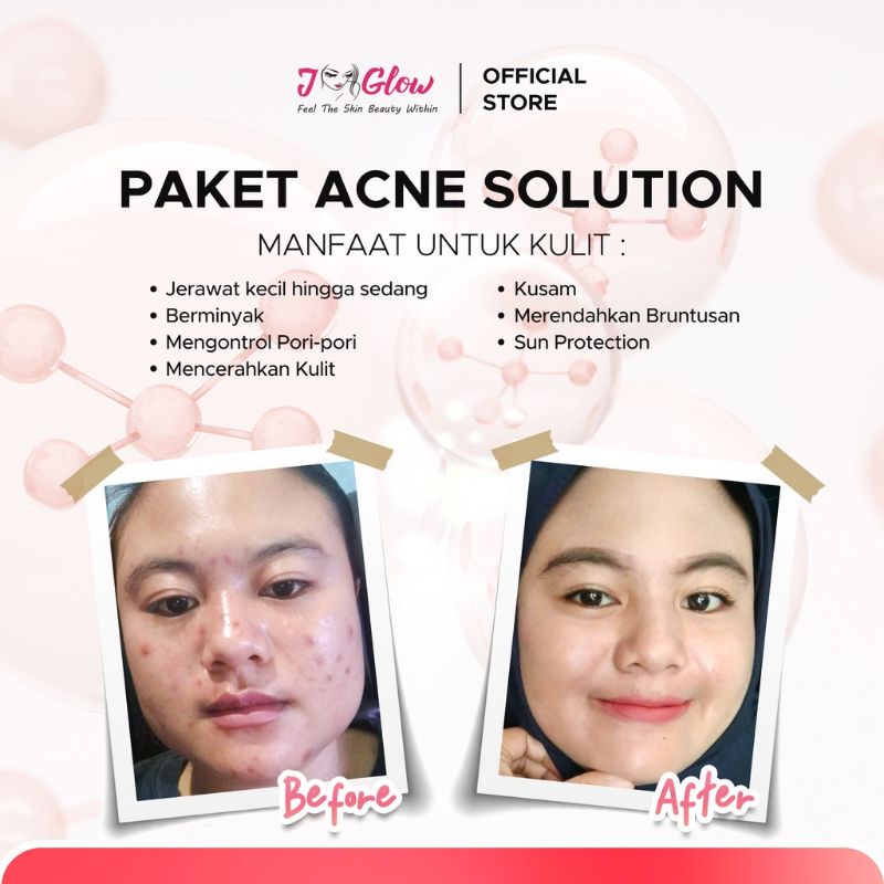 Jglow Skincare Paket Acne Solution Whitening / Rangkaian Skincare Glowing Untuk Perawatan Wajah Berjerawat Ringan Beruntusan Berminyak Bpom