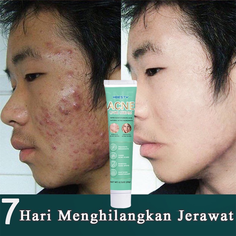 Penghilang jerawat Serum Gel jerawat Perawatan jerawat wajah Serum wajah acne 20G Menghilangkan jerawat, Bekas jerawat, Memudarkan bekas jerawat Esensi herbal Dengan lembut, aman dan cepat menghilangkan semua jenis jerawat dan bekas jerawat